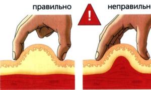 Как правильно делать уколы в ягодицу Инструкция по выполнению укола в ягодицу