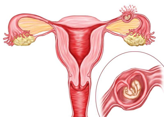 Тянет яичник при беременности на ранних сроках